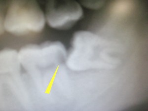 左下の智歯の前の虫歯