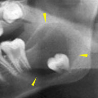 濾胞性歯牙嚢胞