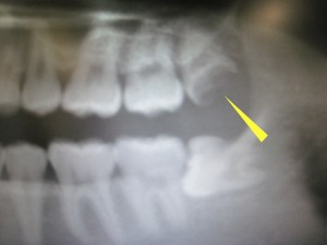 左上の智歯の虫歯